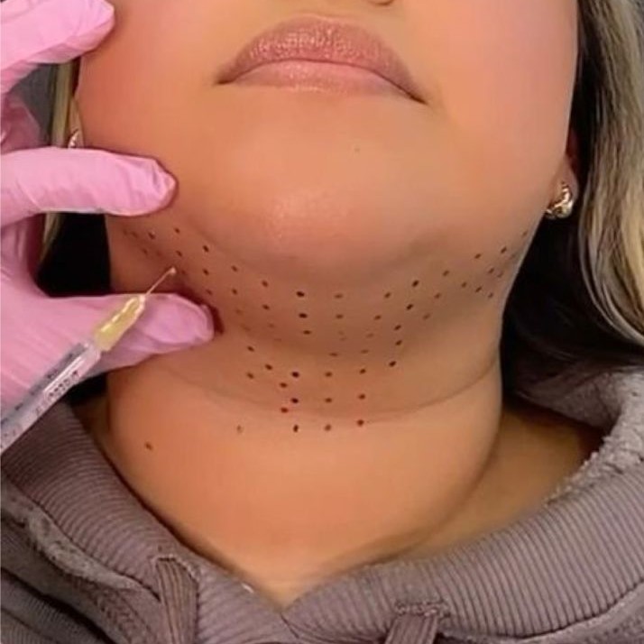 Double Chin